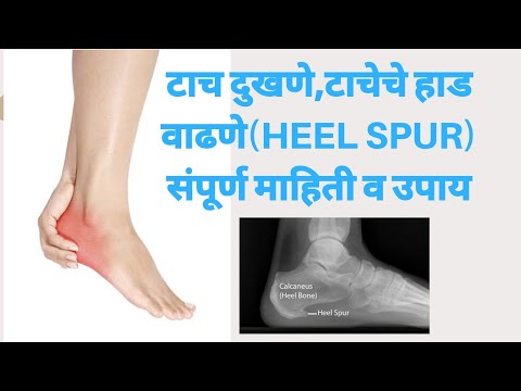 टाच दुखी,टाचेचे हाड वाढणे(Heel spur) || संपूर्ण माहिती व उपाय || PV LIFE