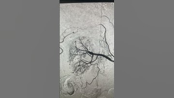 Renal aneurysm glue embolization