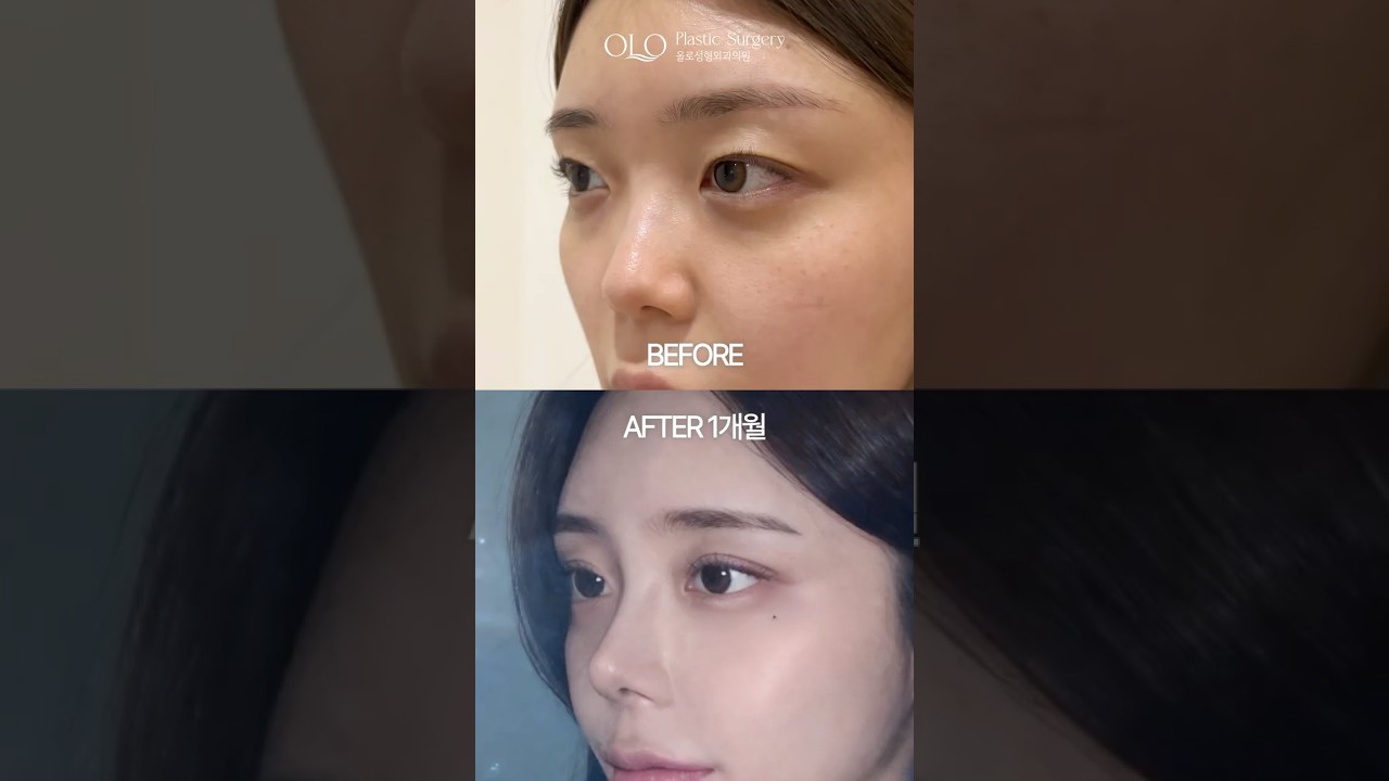 [奧洛整形外科診所] 在奧洛，變得更精緻、更漂亮地蛻變 🤭 埋線提眼瞼肌矯正 + 異體肋軟骨隆鼻 真實術前術後對比！ #奧洛整形外科 #埋線雙眼皮 #異體肋軟骨隆鼻 #狎鷗亭整形外科 #異體肋軟骨術前後 #隆鼻術前後 #美眼神培醫師