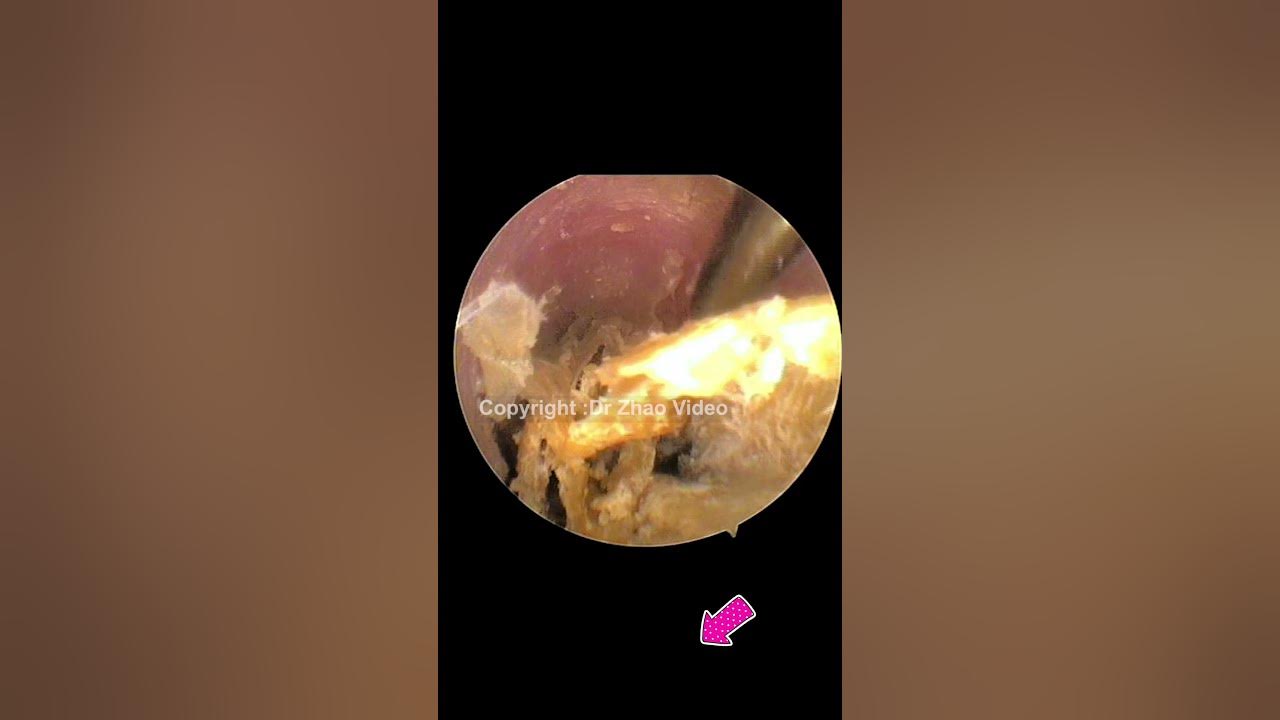 Satisfying Ear Wax Removal Extraction With Dr Zhao Shorts 21 YouTube