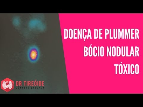 Vídeo: Bócio Difuso Tóxico - Sintomas, Graus, Tratamento