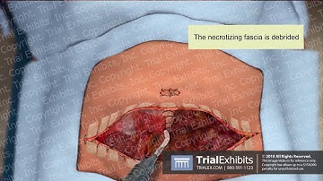 Debridement of Necrotizing Fasciitis and Exploratory Laparotomy