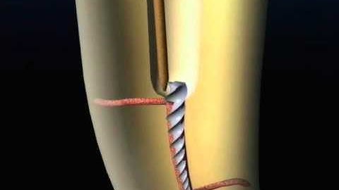 Removal of separated instrument with ultrasonics | Dentsply Sirona