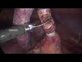 Laparoscopic appendicectomy drmdabdullah al mamun