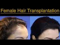 Female Hair Transplantation Result in 1 Years | @ Eugenix by Expert Hair Restoration Surgeons