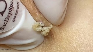 Milia, Big Cystic Acne Blackheads Extraction Whiteheads Removal #Part 01