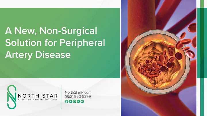 A New, Non-Surgical Solution for Peripheral Artery Disease