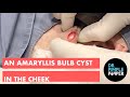 An Amaryllis Bulb Cyst in the Cheek