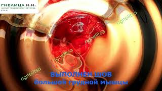 разрыв большой грудной мышцы - пластика мышцы (по специальной методике - хирург Гнелица Н.)