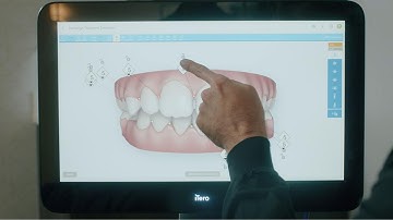 General dentist reviews the iTero Lumina™ | Early detection and case acceptance