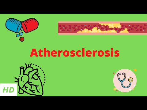 Atherosclerosis, Causes, Signs and Symptoms, Diagnosis and Treatment.