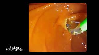 Management of a malignant hilar stricture using the Exalt single-use duodenoscope