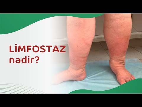 Limfostaz nədir? Limfostazın səbəbləri və müasir müalicə üsulları