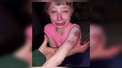 10-year-old girl with special needs ‘brutally’ bitten on school bus, parents say - DayDayNews