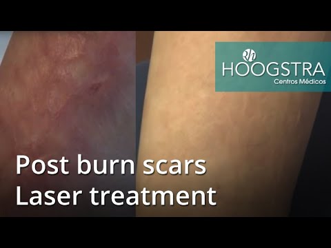 Video: Burn Scars: Léčba A Další