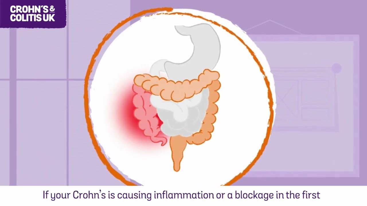 Surgery for Crohn's Disease