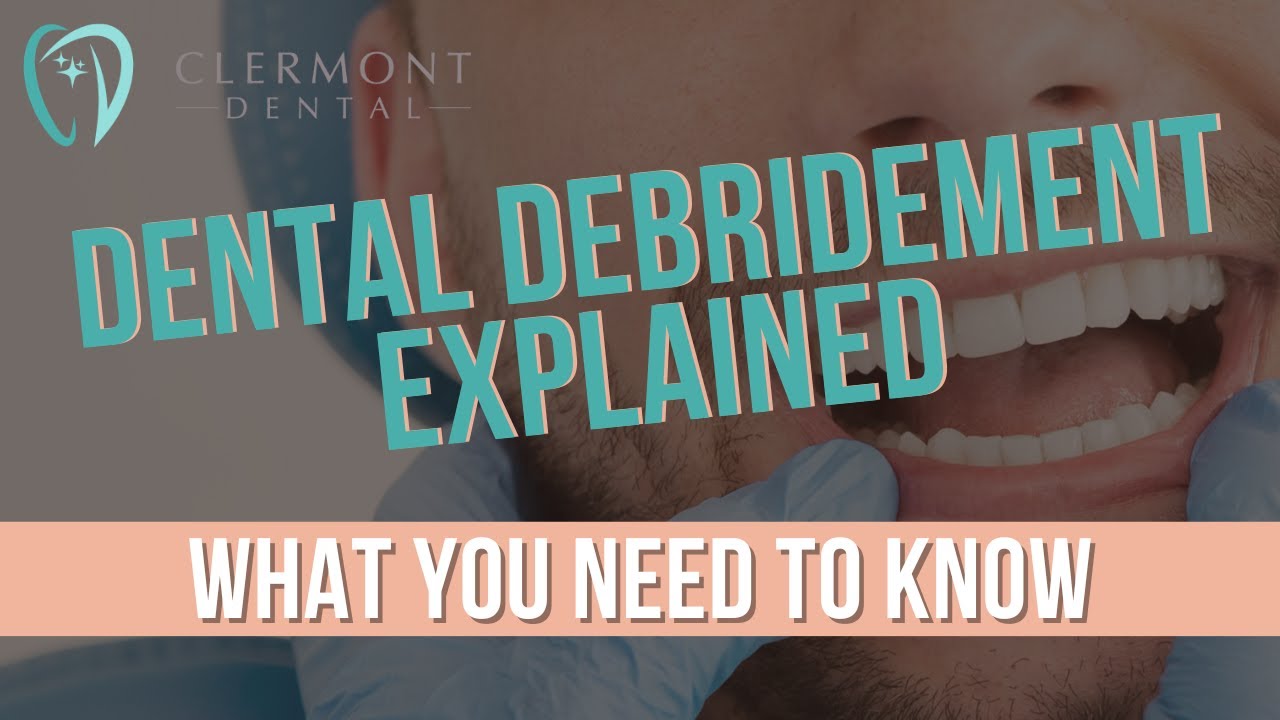 DENTAL DEBRIDEMENT EXPLAINED What You Need To Know Debridement DENTAL DEBRIDEMENT EXPLAINED What You Need To Know Debridement