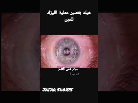 هيك بتصير عملية الليزك للعين