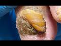 Amazing Toenails, Too Thick, Trim Them Slowly【Xue Yidao】