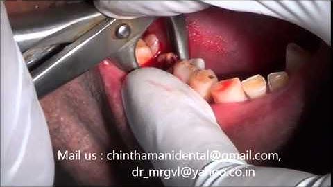 Painless extraction of molar rootstumps and immediate implants in India video part 1