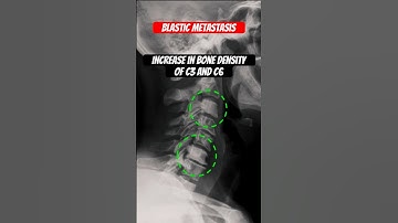 Metastatic spread of Cancer to the Spine #shorts #medical #doctor