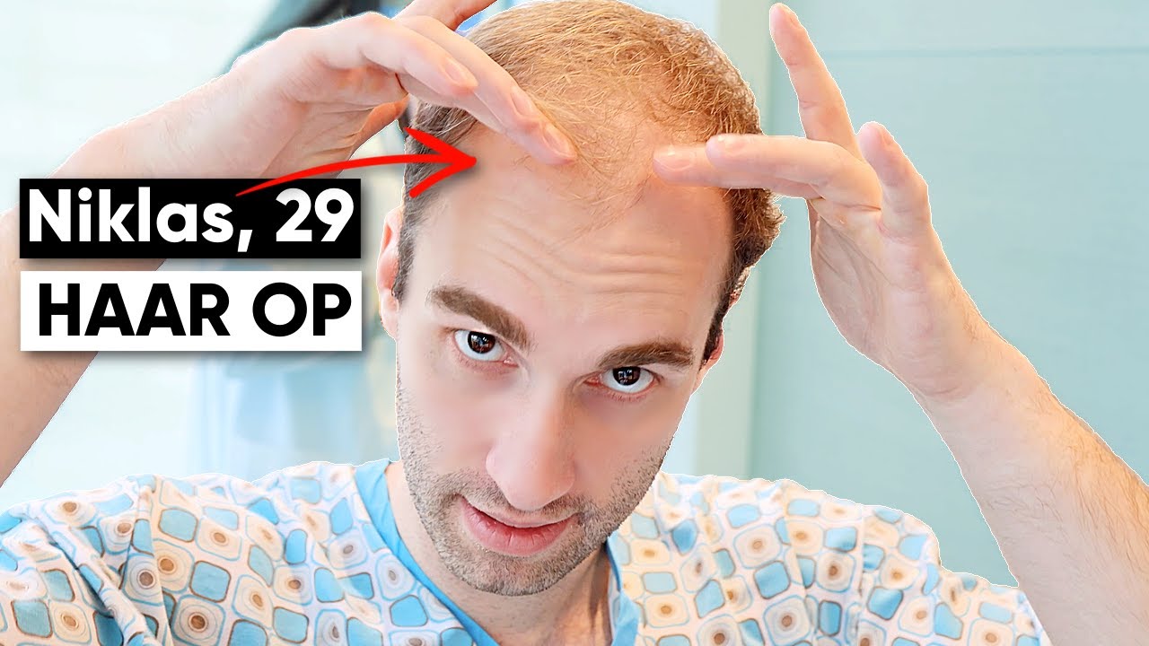 Niklas bekommt über 5000 neue Haare - Haartransplantation | Erfahrung