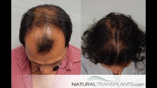 Hair Transplant Results Video:100s of before and after hairline surgery photos