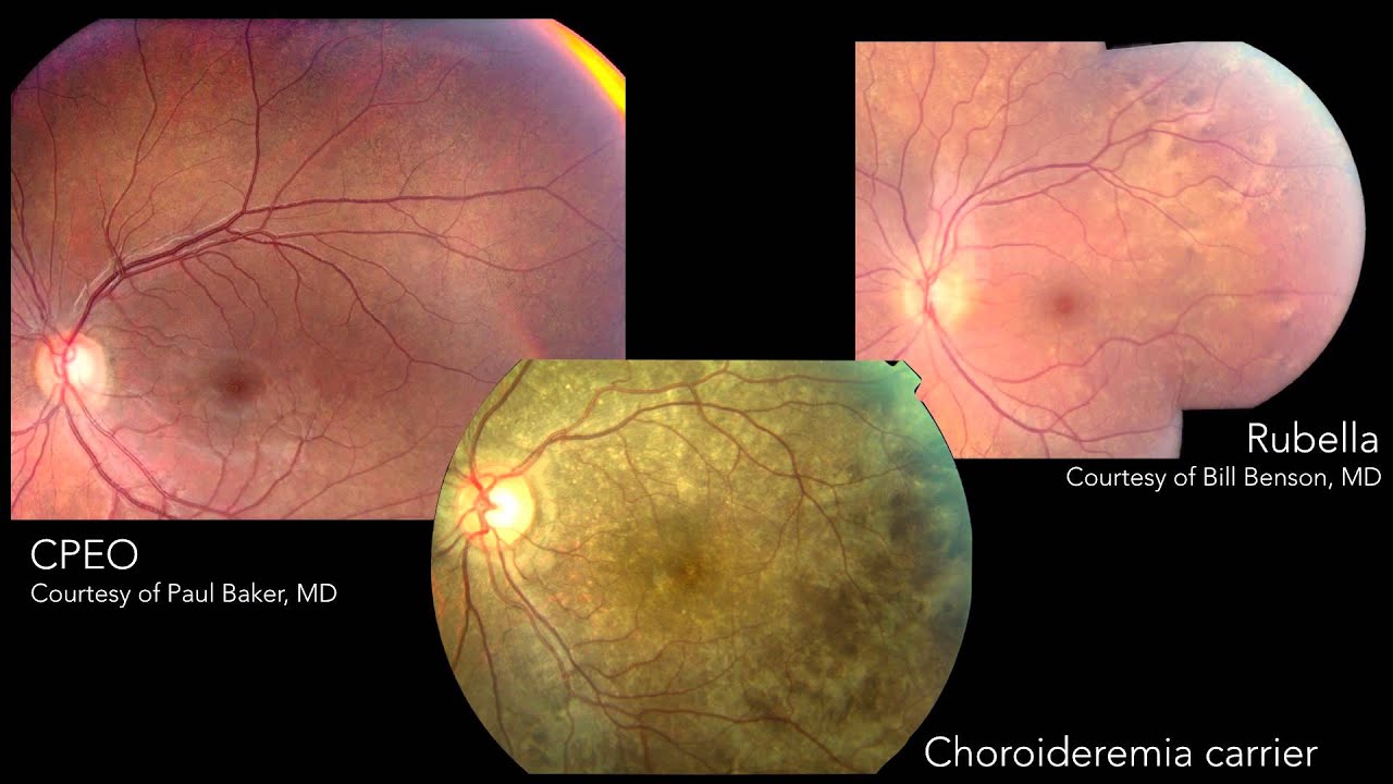 infectious posterior uveitis youtube posterior uveitis