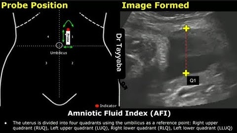 How To Measure Amniotic Fluid Index (AFI) On Ultrasound | Probe Positioning & Scanning Technique USG