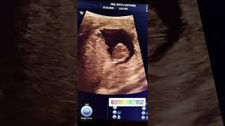 Kiz Bebegimiz. Ci̇nsi̇yet Tespi̇ti̇. . 12. Gebelik. Dr. Mehmet Boz