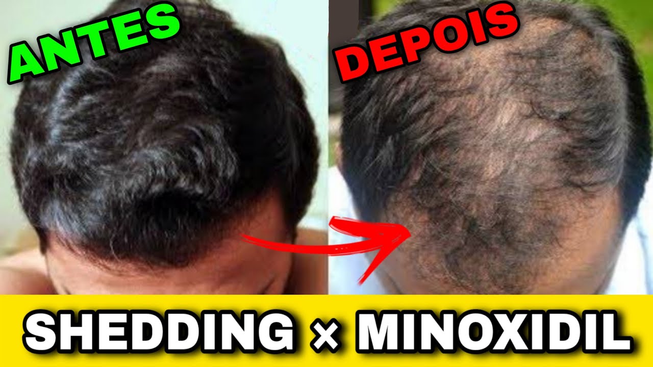 SHEDDING X MINOXIDIL cabelo Caindo No Tratamento YouTube SHEDDING X MINOXIDIL cabelo Caindo No Tratamento YouTube