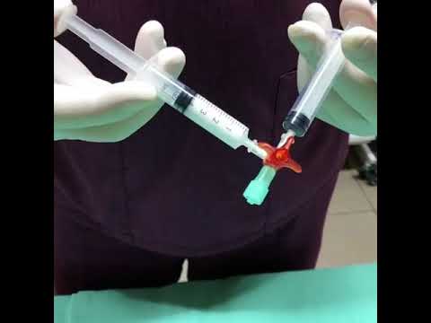 Приготовление пены для проведения пенной склеротерапии варикозных вен