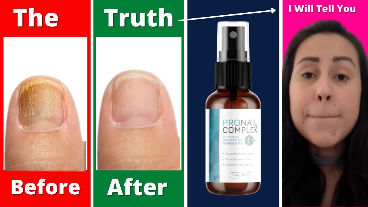 PRONAIL COMPLEX REVIEW⚠️(DO NOT BUY BEFORE WATCHING!)⚠️PRONAIL COMPLEX REVIEWS- PRONAIL FUNGUS