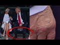 What Is That Spot On President Trump S Hand What Is That Spot On President Trump S Hand