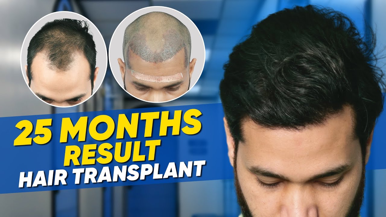 Hair Transplant in Spain Best Results & Cost of Hair Transplant in Spain YouTube