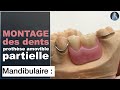 Montage des dents prothtiques mandibulaires  prothse amovible partielle  prothse dentaire  