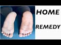 HOME REMEDIES FOR CRACKED HEELS | REMOVE CRACKED HEELS AT HOME | GRACIOUS CHIOMA