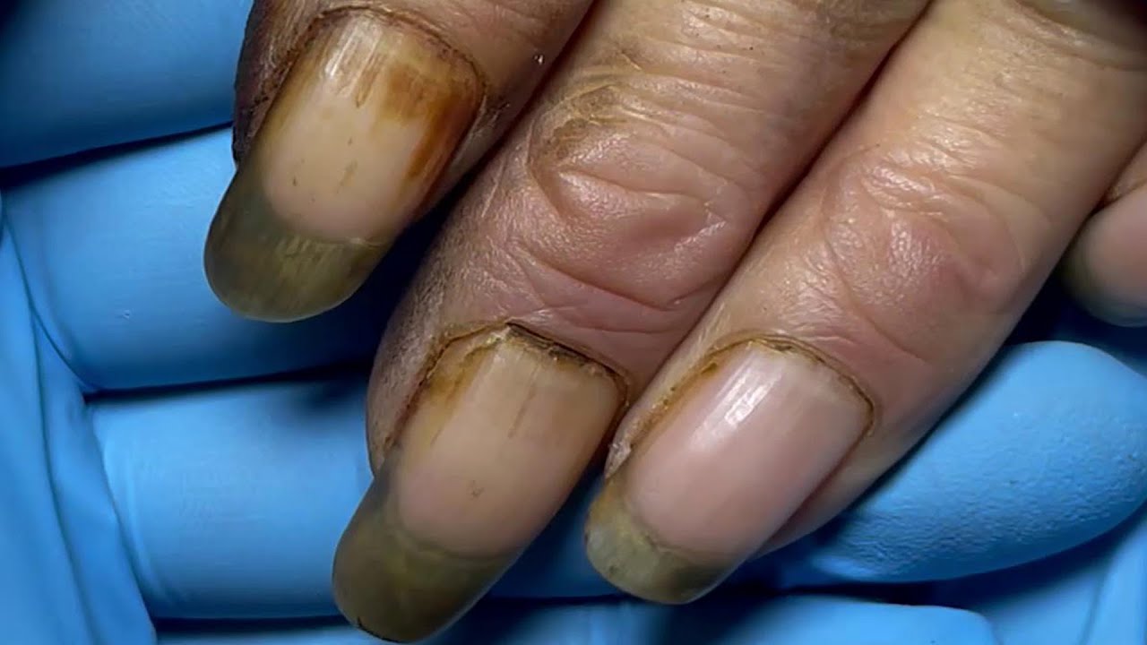 Diagnosing nail disorders: an illustrated guide