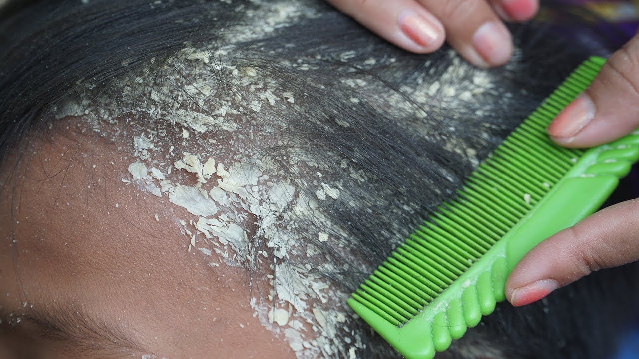Deep Flake Cluster Removal — Most Satisfying Peel of the Day #265 - YouTube