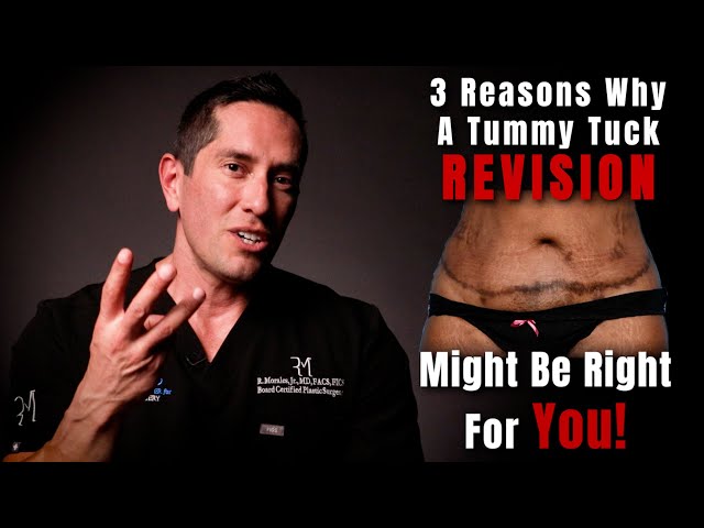 3 Reasons You May Need A Tummy Tuck Revision 