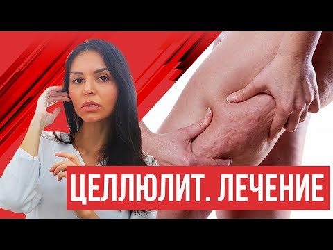 Целлюлит. Профилактика и лечение