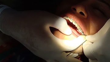 Advance sync 2 insertion for adult class II div 2 case