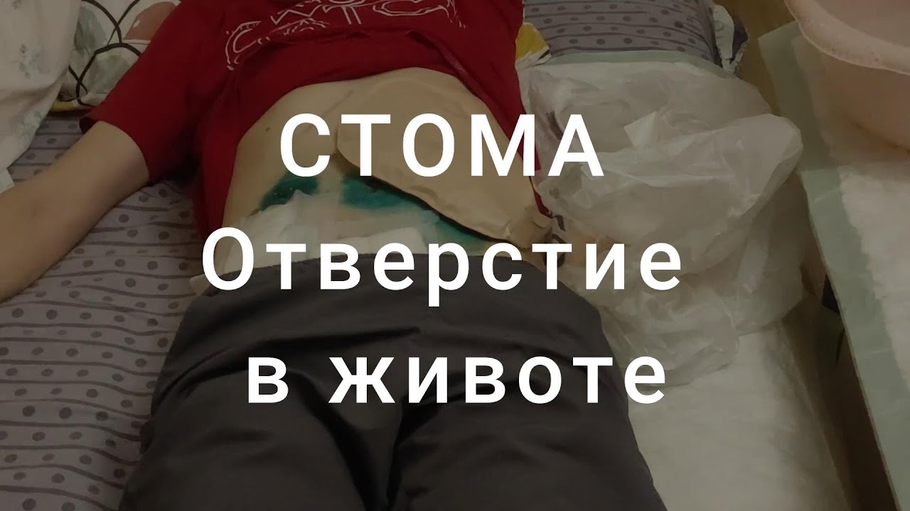 Стома. Замена калоприемника. - YouTube