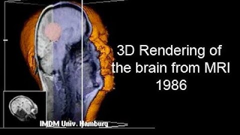 3D Reconstruction of the brain from MRI 1986