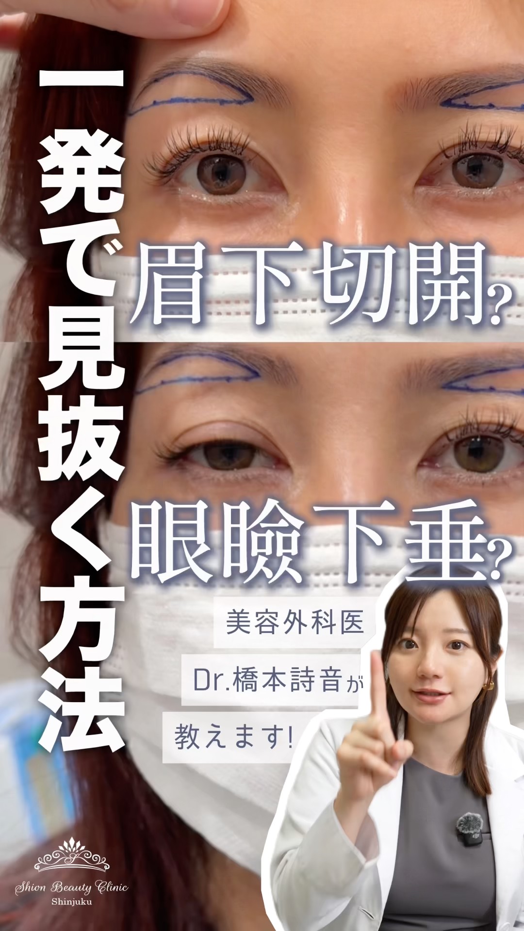 Should I get a brow lift? Or should I get eyelid surgery? I'll