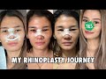 MY RHINOPLASTY JOURNEY - Was it worth it? | Jen Barangan