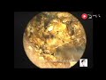 Removal of external auditory canal cholesteatoma by ear endoscopy, 19 minutes