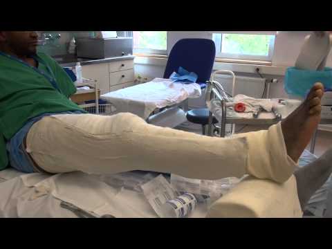 Vidéo: Comment attelle une fracture de la jambe inférieure : 13 étapes