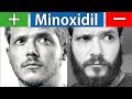 Die Vor und Nachteile von Minoxidil | Kurz und Knapp