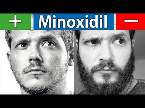 Die Vor und Nachteile von Minoxidil | Kurz und Knapp